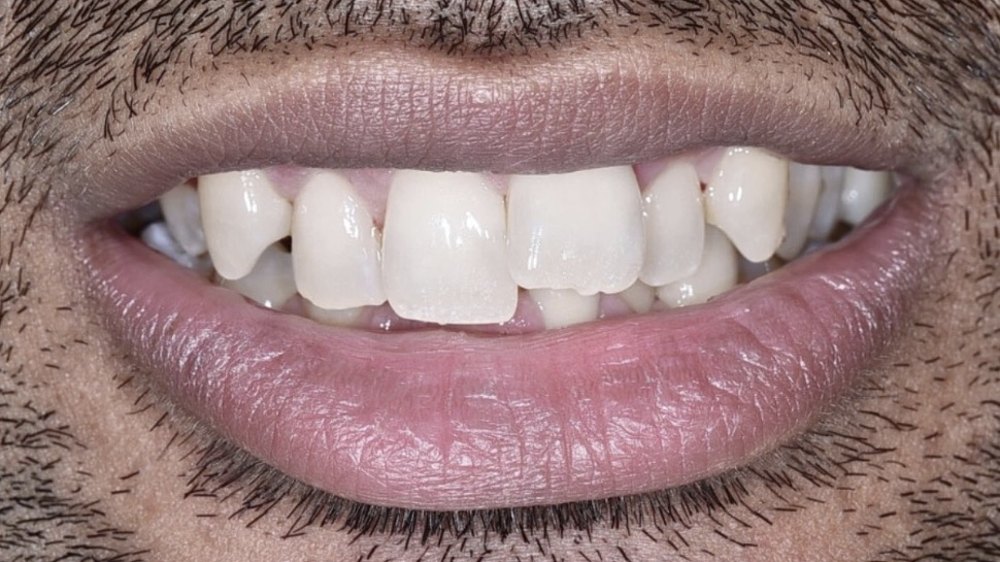Before clear aligner treatment — crowded, protruding upper front teeth