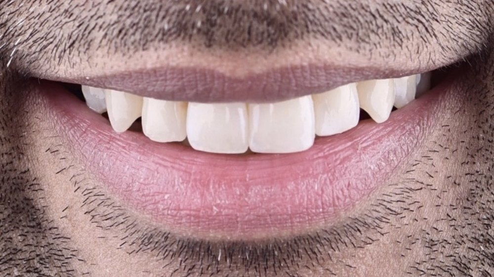 After clear aligner treatment — straightened, even upper front teeth