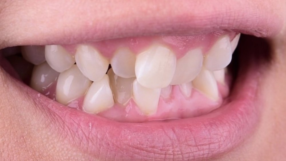 Before clear aligner treatment — crowded lower teeth
