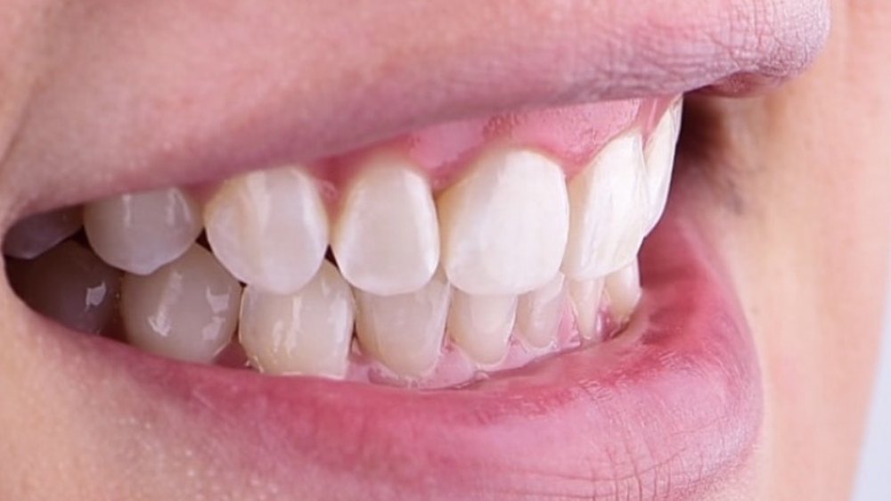 After clear aligner treatment — aligned lower teeth