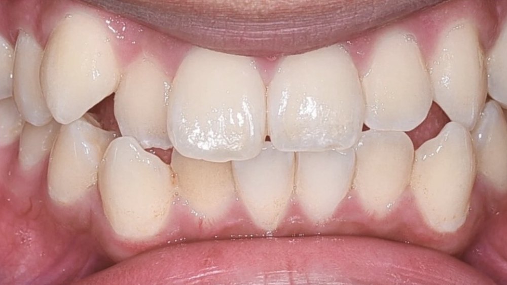 Before clear aligner treatment — gaps and spacing