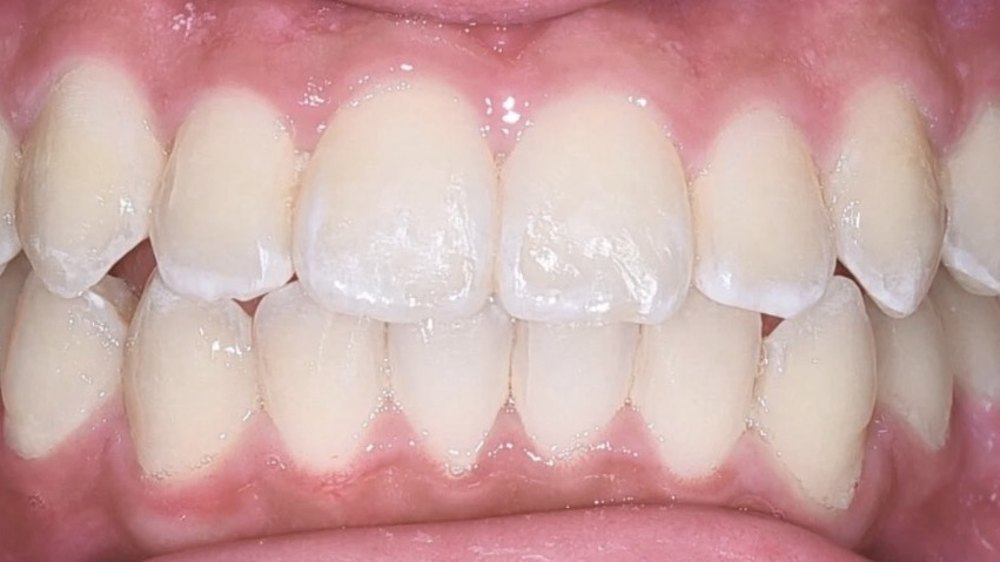 After clear aligner treatment — gaps closed