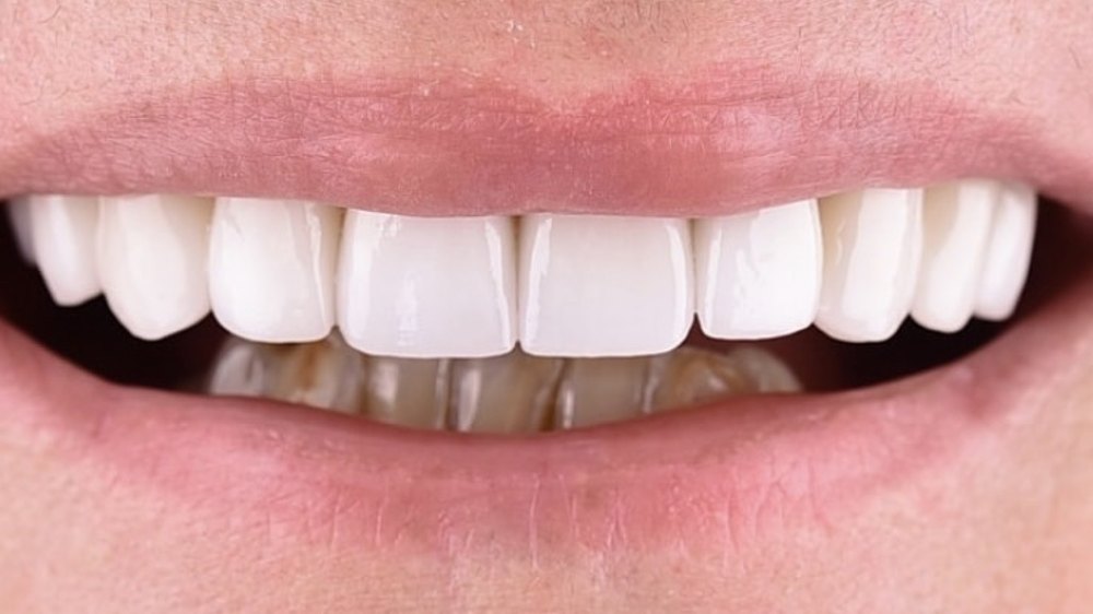 After clear aligner treatment — even, level smile