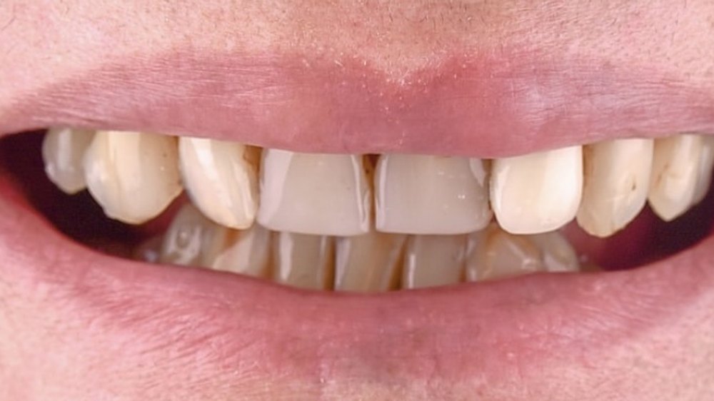 Before clear aligner treatment — uneven tooth edges