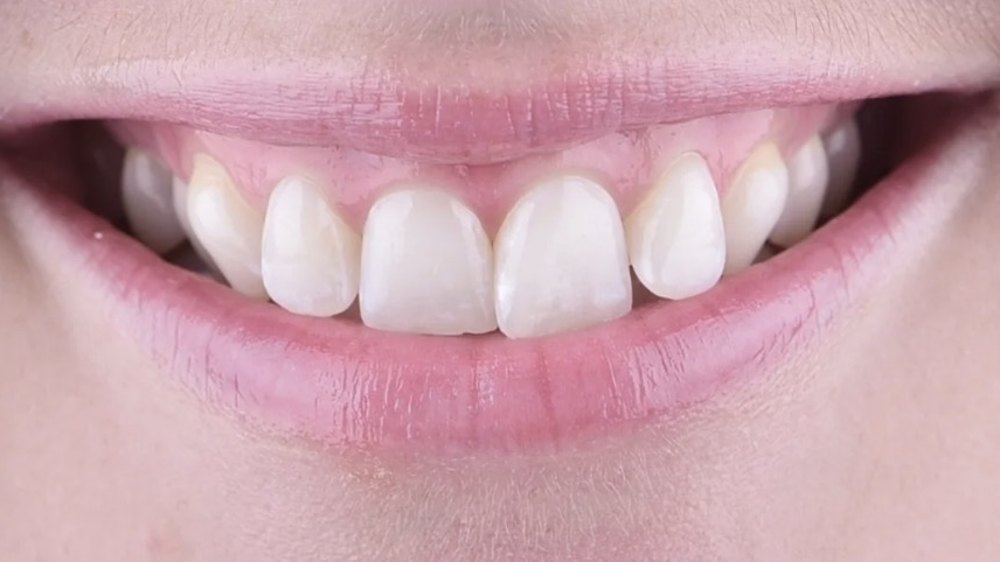 Before clear aligner treatment — mild crowding