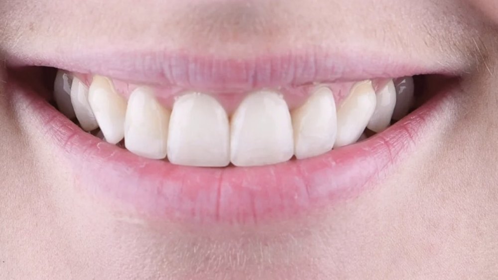 After clear aligner treatment — aligned teeth