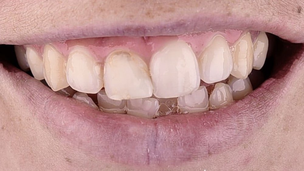 Before clear aligner treatment — misaligned front teeth