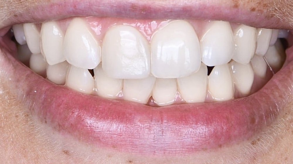 After clear aligner treatment — straightened front teeth