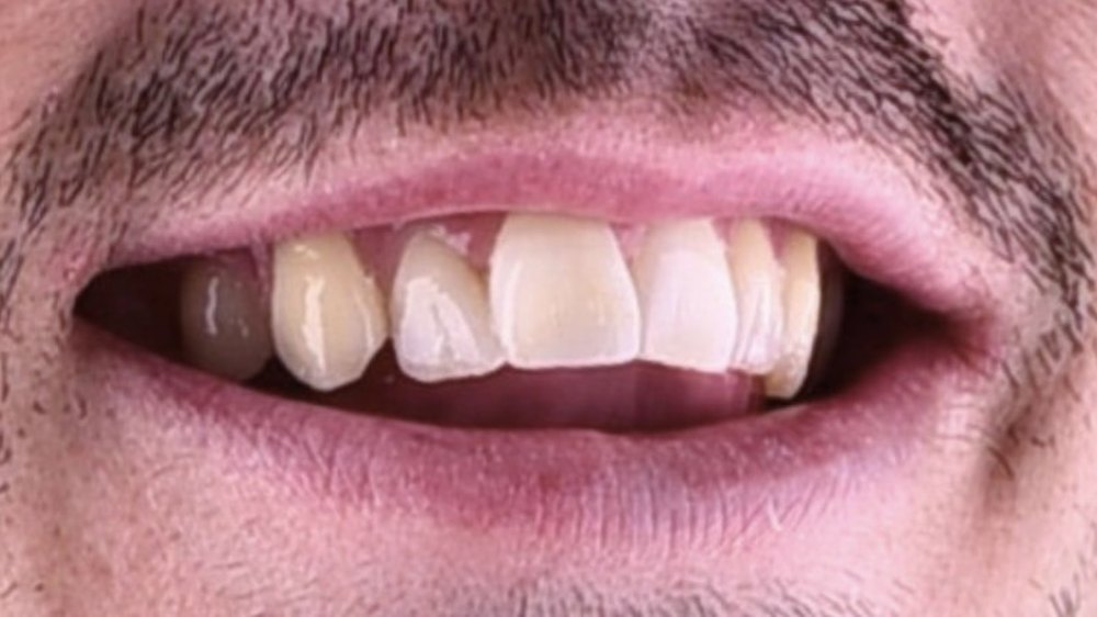 Before clear aligner treatment — crowded teeth