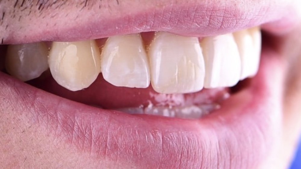 After clear aligner treatment — aligned smile