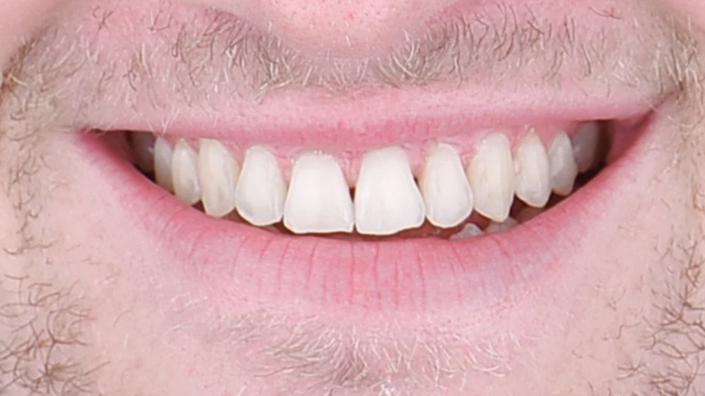 After clear aligner treatment — straightened smile