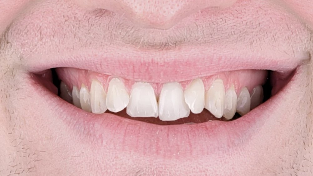 Before clear aligner treatment — uneven, gapped front teeth